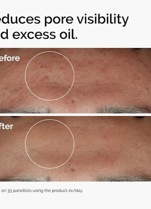 Niacinamida 10% + Zinc 1% Suero 30ml Mejora el brillo de la piel Fortalece la barrera de humedad de la piel Mejora la textura Reduce el exceso de aceite